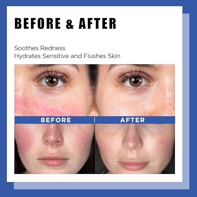 It'S SKIN LI Calming Skincare Set - Soothing Toner Pads, Ampoule Serum, Moisture Cream – Redness & Acne Relief with Licorice Extract & Guaiazulene – for Clear Skin