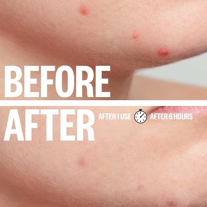 a.l.m. Magical Patch (2) Hydrocolloid pimple patches. These ultra thin & translucent hydrocolloid adhesive covers and absorb unwanted pimples. Parches Para Acne for skincare.