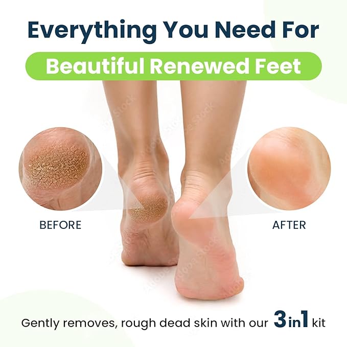 Tea Tree Oil & Citrus Detox Foot Soak with Epsom Salts & Callus Remover for Feet with Extra Strength Gel & Foot Pumice Stone Set