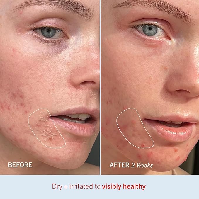 First Aid Beauty - Ultra Repair Cream, Intense Hydration Whipped Colloidal Oatmeal, Clinically Proven to Strengthen Skin Barrier & Help Relieve Eczema, Face & Body Moisturizer, 14oz Fresh Strawberry