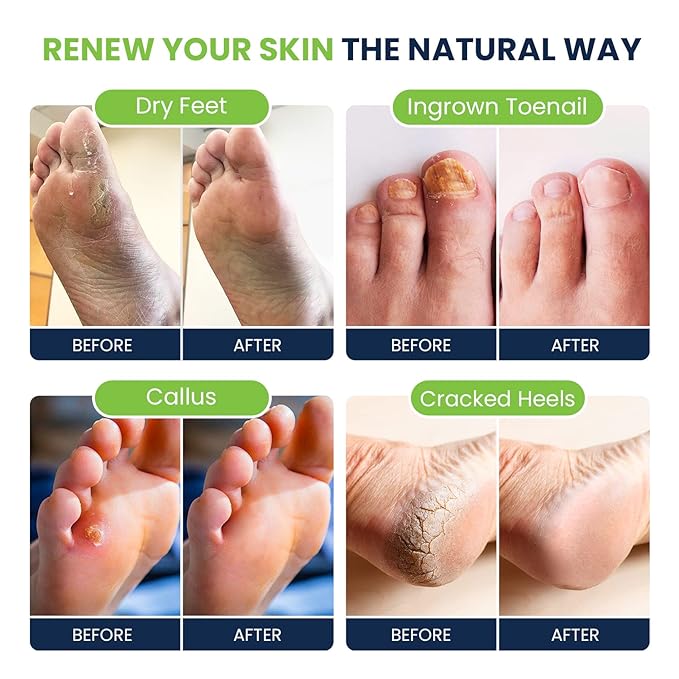 Tea Tree Oil Foot Cream - Moisturizing Athletes Foot Care For Dry Cracked Feet Cream - Heel & Callus Removal,& Tea Tree Foot Soak, Callus Remover Gel Foot File Pedicure Kit