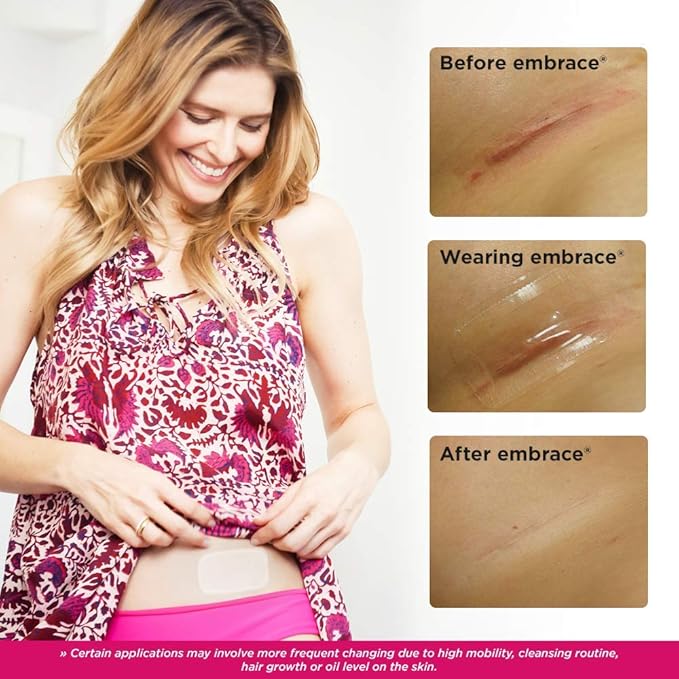 Embrace Active Scar Defense for New Scars, FDA-Cleared Silicone Scar Sheets, 2.4 Inch, Medium, 60 Day Supply (Recommended Treatment)