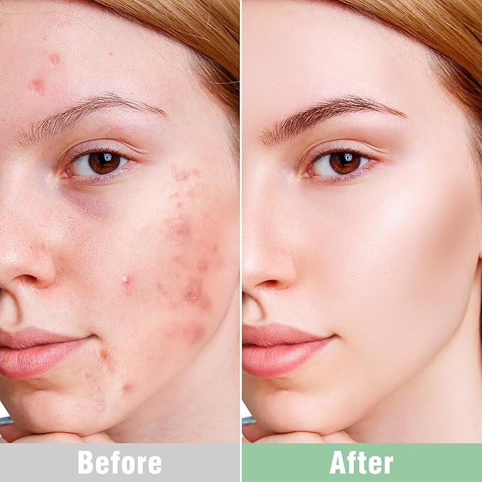 ISTON Overnight Hydrogel Face Mask for All Skin