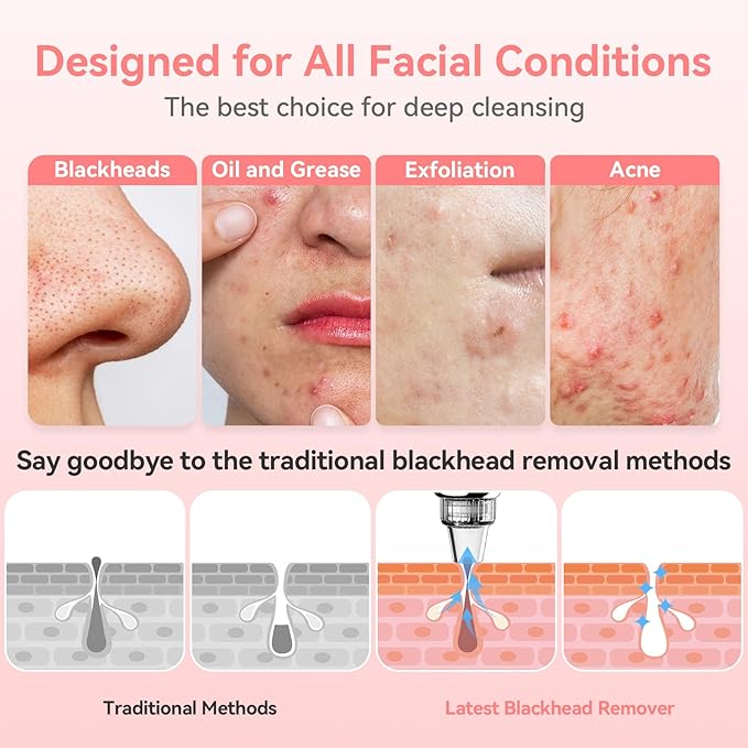 Blackhead Remover Pore Vacuum Upgraded Facial Pore Cleaner Electric Comedone Whitehead Extractor Tool-5 Suction Power,5 Probes,USB Rechargeable Blackhead Vacuum Kit for Women & Men