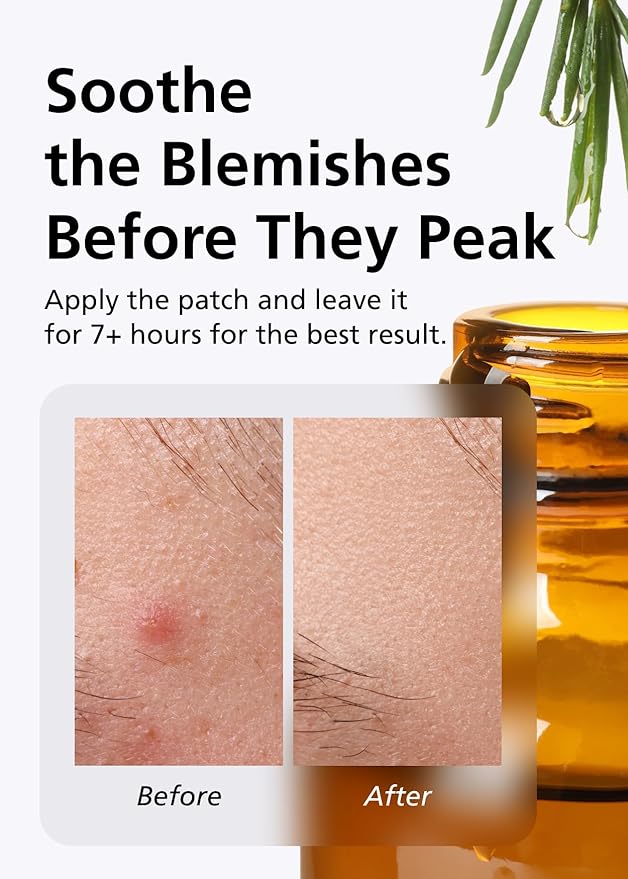 EasyDerm Relief Invisible Patch 2 Packs(84 counts) Contains 10,000 ppm of Tea Tree Oil, Pimple Patch, Ultra slim 0.1mm, Waterpoof, Korean Pimple Patches