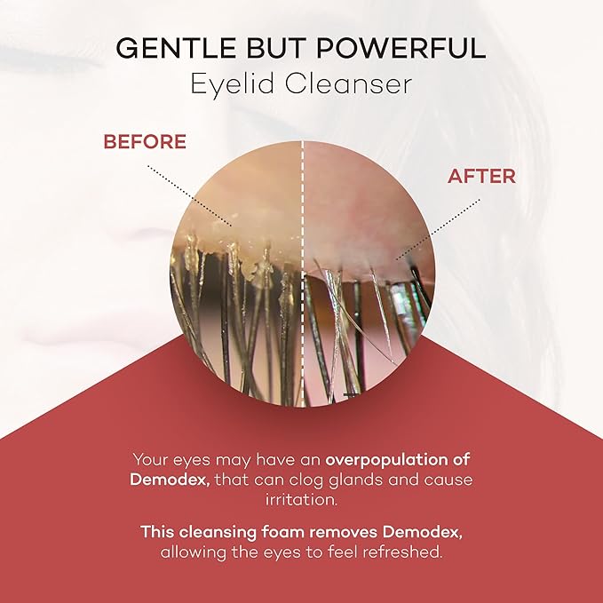 ZocuFoam Eyelid Cleanser - Foaming Eyelid Scrub - Natural pH Balanced Solution - 25mL