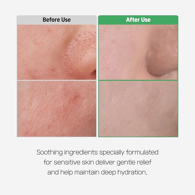 Cica Bio Spot Control Patch (1 Box, 62pcs) | Soothing Acne Patch for Redness & Blemishes | With Cica, Niacinamide & Tea Tree | Gentle for Sensitive Skin | Korean Skincare