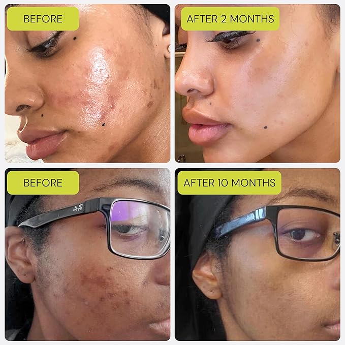 Gleamin Vitamin C Clay Mask for Dark Spots, Turmeric Clay Face Mask Skin Care, Deeply Cleanses & Refines Pores, Brightens Uneven Tone and Helps Improve Post-Blemish Scarring & Texture - 5 Oz