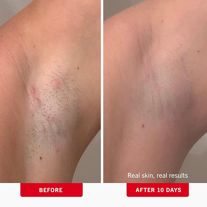 First Aid Beauty - Ingrown Hair Pads with BHA + AHA - Aftershave Treatment Pads to Help Prevent Razor Bumps for Men & Women - Exfoliate Underarms & Bikini Area - Compostable for Daily Use - 28 Pads